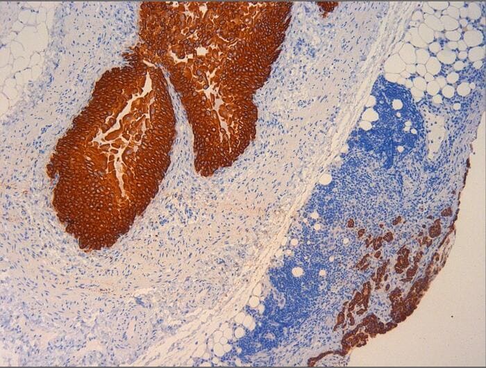 Image of Pancytokeratin_lymph node metastasis
